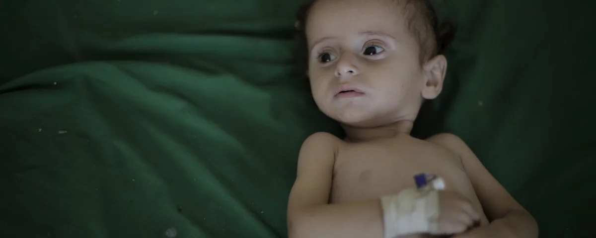 Jemen unterernährtes Kind 