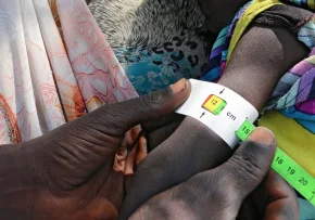 Mangelernährung Hunger | Foto: Foto: epd bild/ WFP George Fominyen
